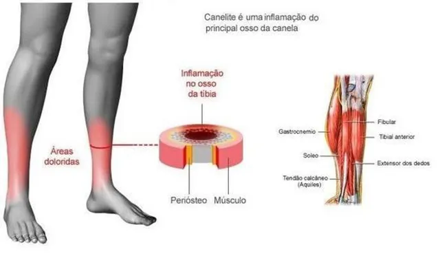 Canelite é uma inflação do principal osso da canela